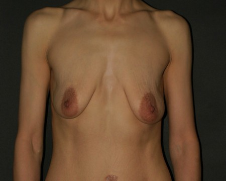 Stretch Marks Empty TITS